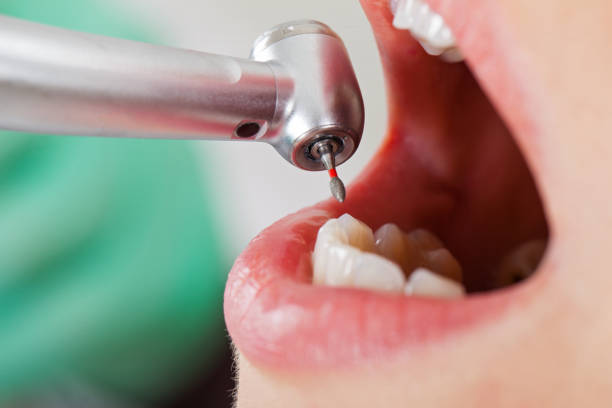 Best Dentist for Tooth Abscess  in Kirbyville, TX